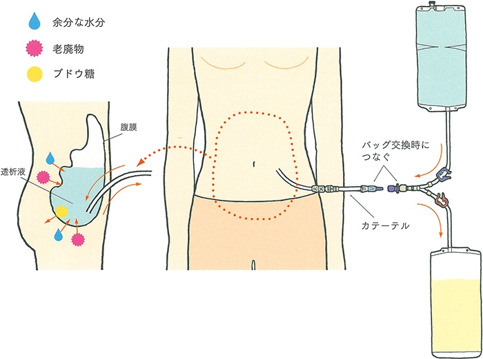 腹膜透析のイメージ